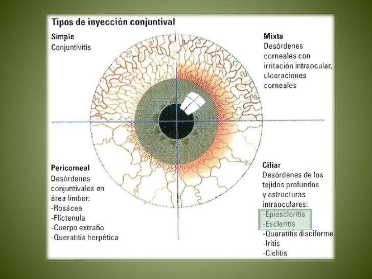 escleritis y epiescleritis